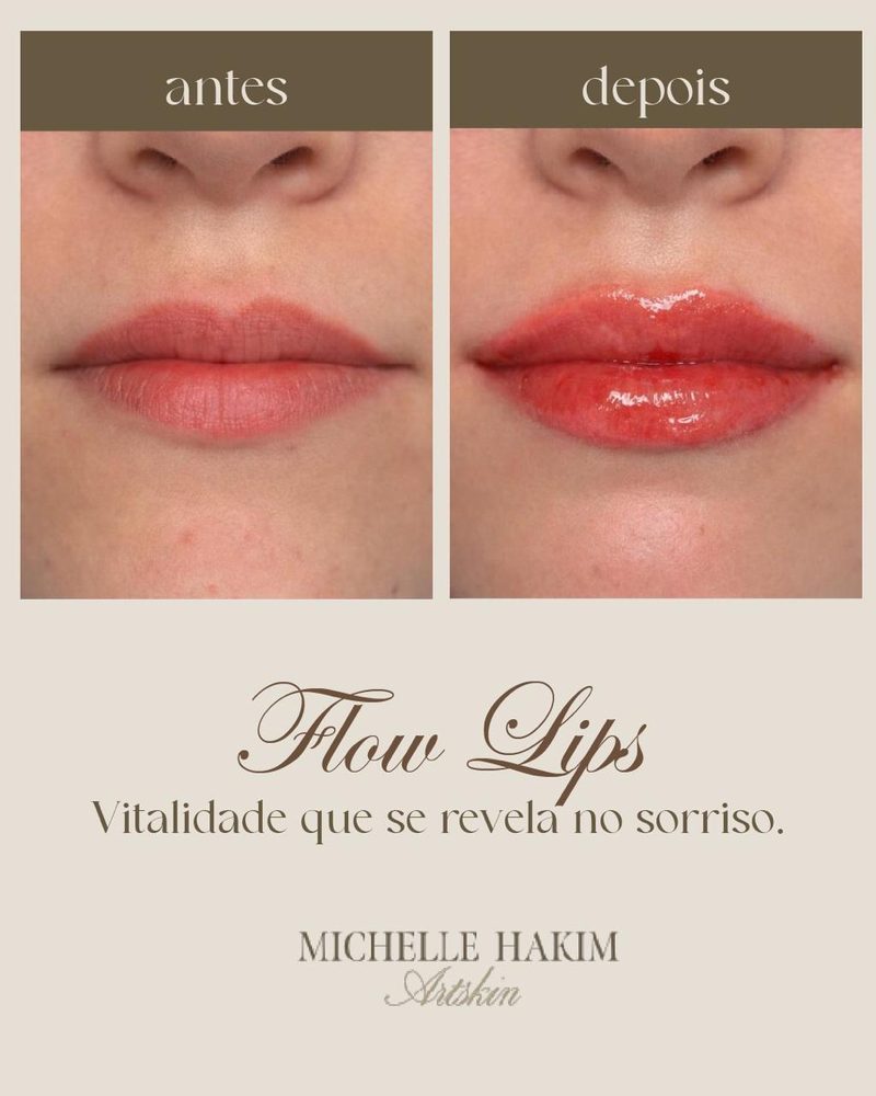 Antes e depois de Flow Lips Technique