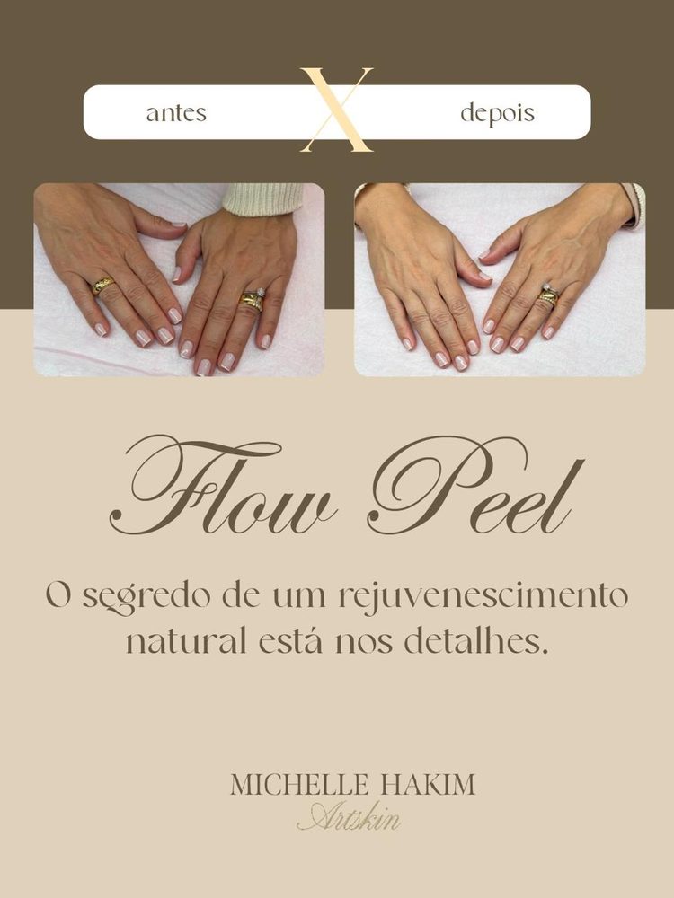 Antes e depois de Flow Peel