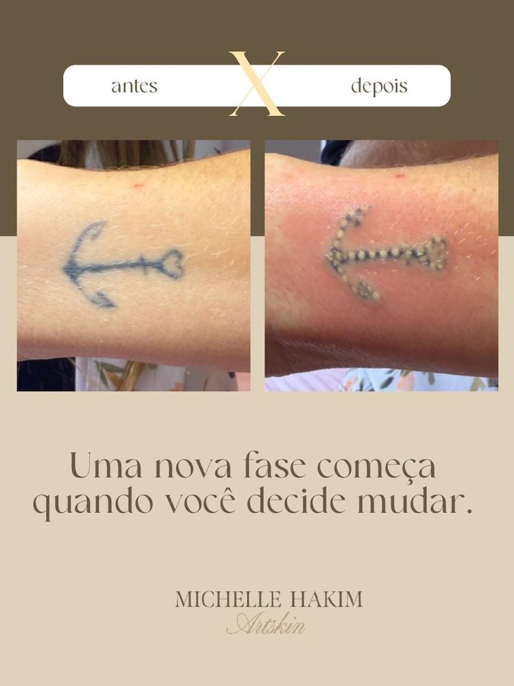 Antes e depois de Flow Removal
