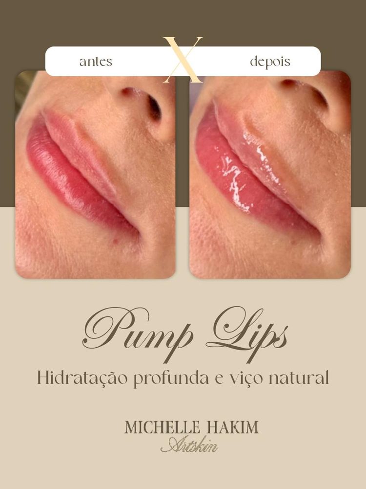 Antes e depois de Pump Lips Technique