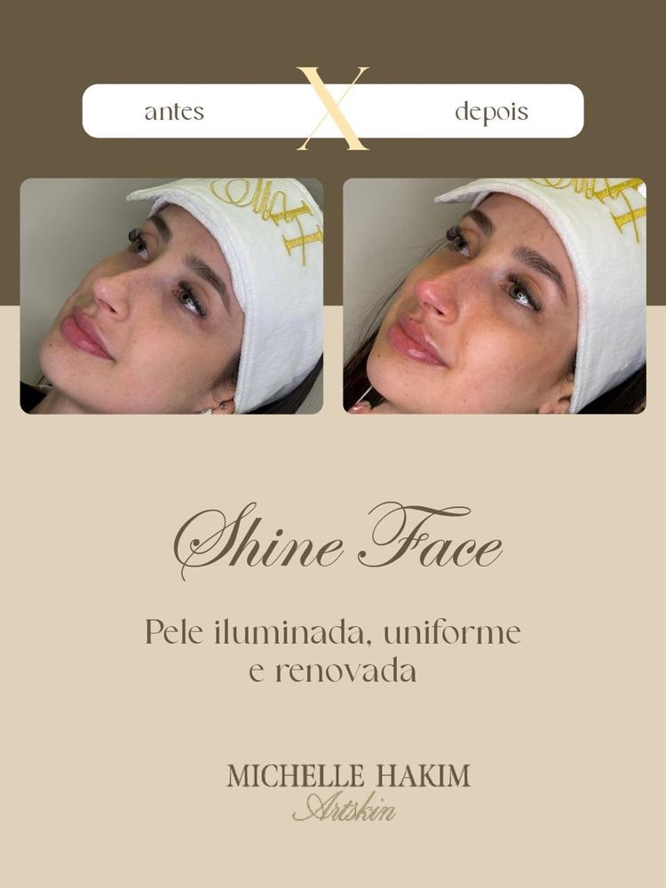Antes e depois de Shine Face
