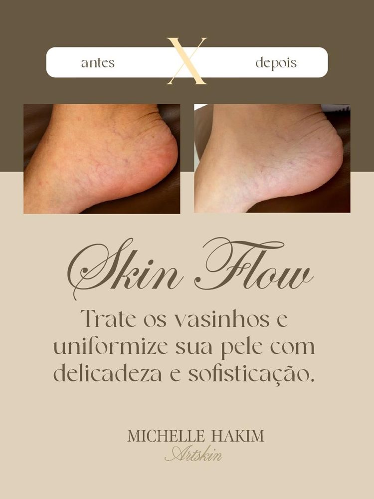 Antes e depois de Skin Flow