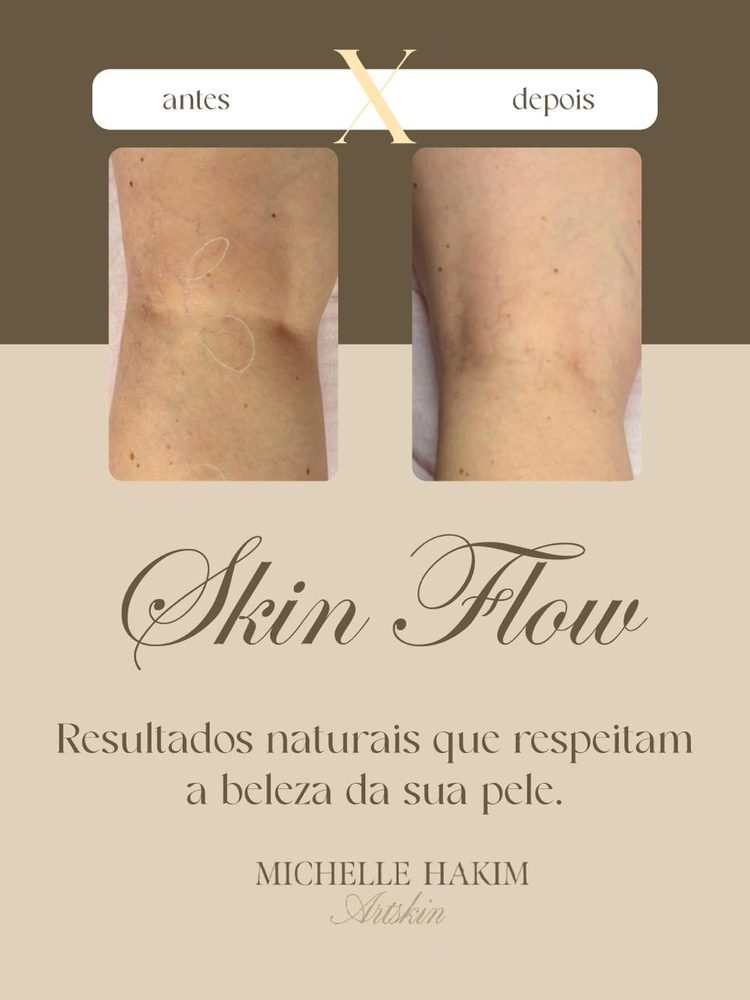 Antes e depois de Skin Flow